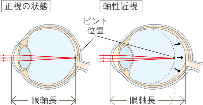 小児期の近視進行抑制が大切な理由の画像